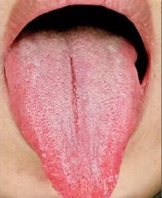 1 Yin-Deficiency Tongue Manifestation.jpg