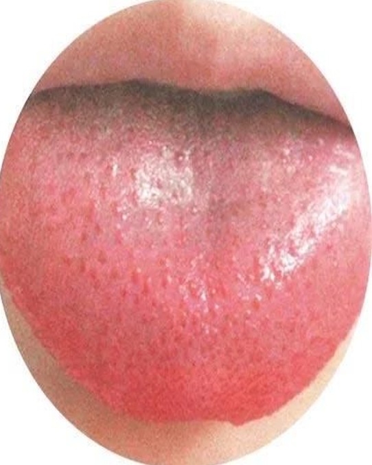 2 Yin-Deficiency Tongue Manifestation.jpg