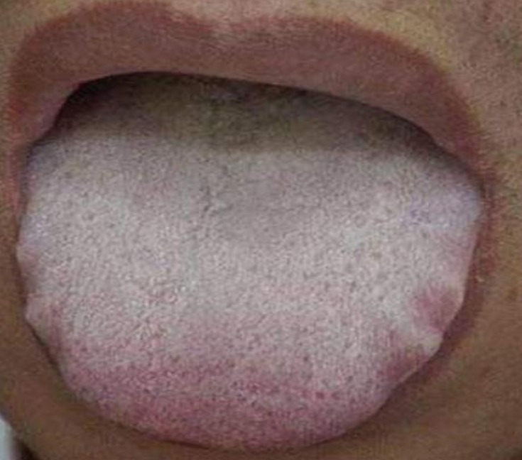 Phlegm - Dampness Tongue Manifestation.jpg