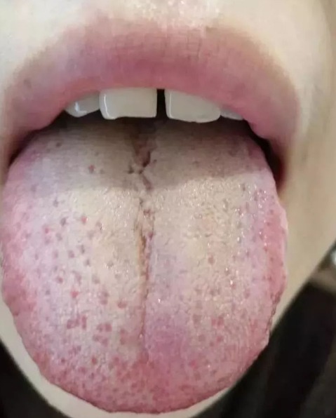 1 Damp - Heat Tongue Manifestation.jpg