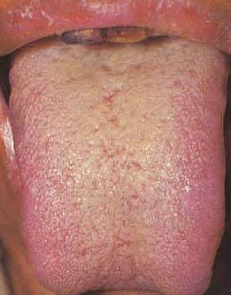 2 Damp - Heat Tongue Manifestation.jpg