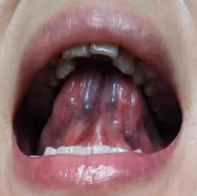 1 Blood - Stasis Tongue Manifestation.jpg