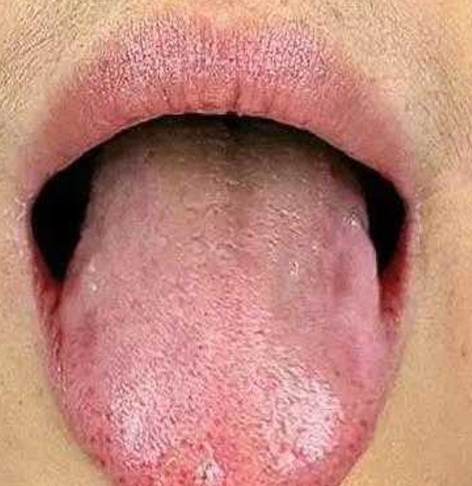 2 Blood - Stasis Tongue Manifestation.jpg